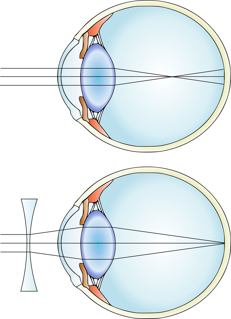 Astigmatism