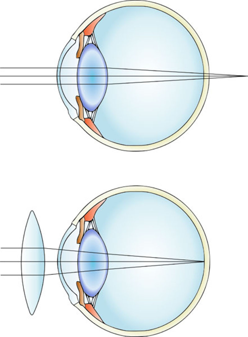 Astigmatism