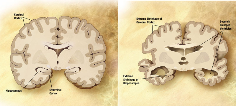 Comparison of a normal aged brain (left) and the brain of a person with Alzheimer's (right). Differential characteristics are pointed out.