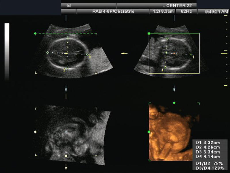 Orthogonal planes of a 3 dimensional sonographic volume with transverse and coronal measurements for estimating fetal cranial volume.