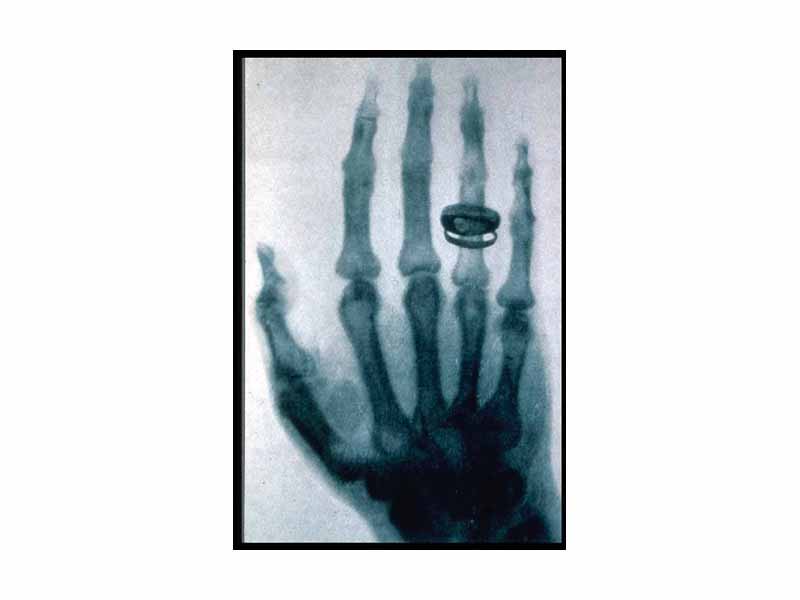 An X-ray picture (radiograph), taken by Wilhelm Röntgen in 1896, of his wife's hand