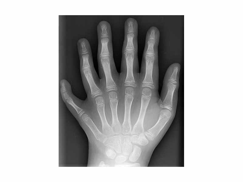 X-ray photograph showing left hand with mid-ray duplication