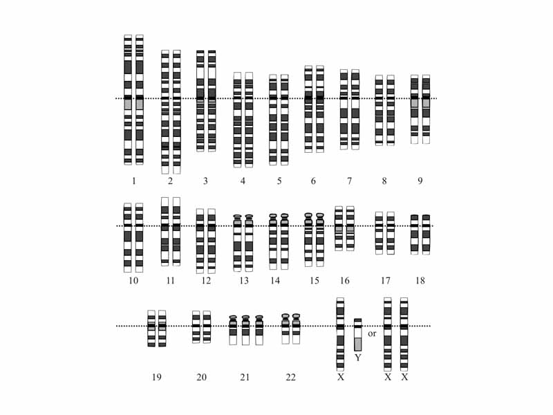 Karyotype for trisomy Down syndrome. Notice the three copies of chromosome 21