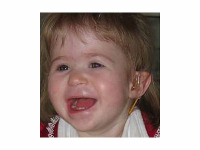 Facial Features of a Child with 1p36 Deletion Syndrome