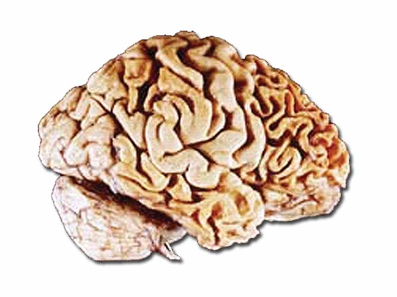 A human brain showing frontotemporal lobar degeneration causing frontotemporal dementia.