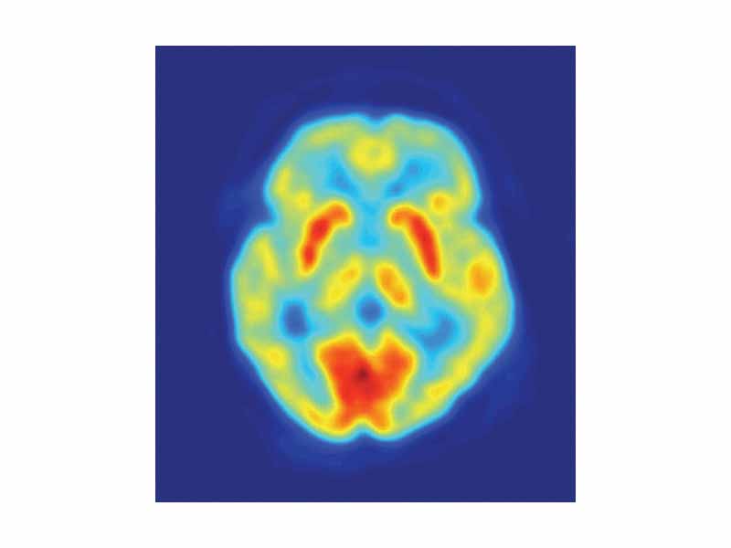 PET Image of the human brain showing energy consumption