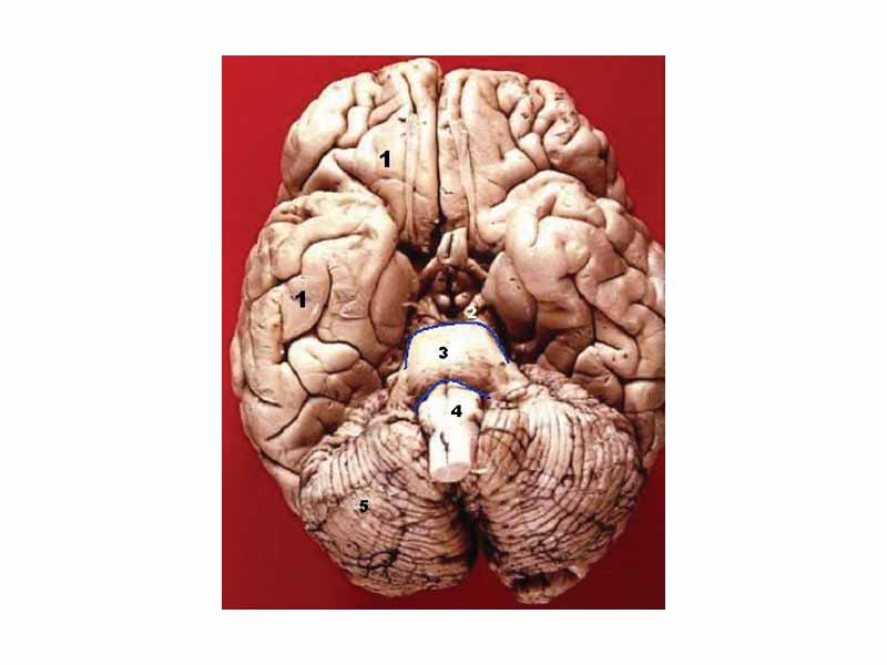 The three divisions of the brainstem are seen here in this anterior- inferior view.  -    -     1. Cerebrum  -     2. Mesencephalon - Midbrain  -     3. Pons  -     4. Medulla oblongata  -     5. Cerebellum