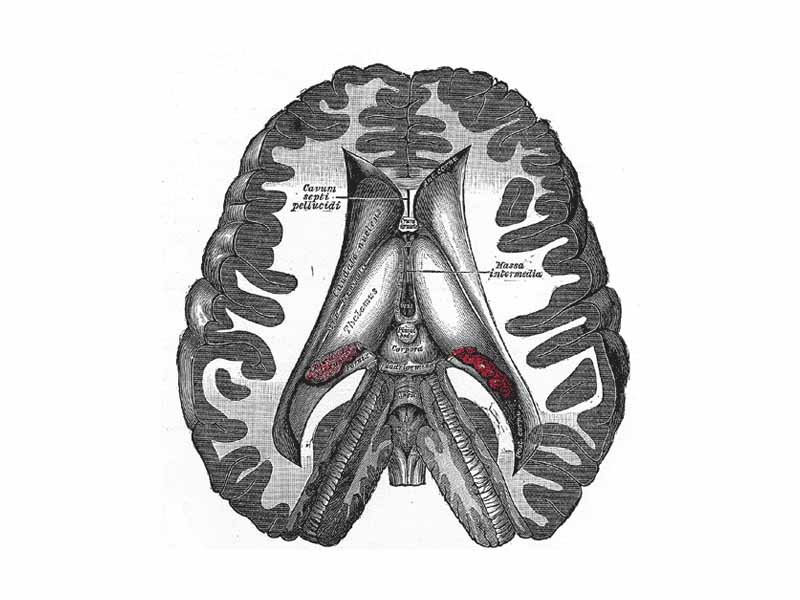 Dissection showing the ventricles of the brain.