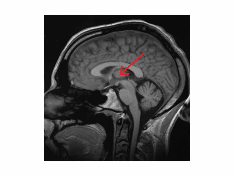 MRI cross-section of human brain, with thalamus marked.
