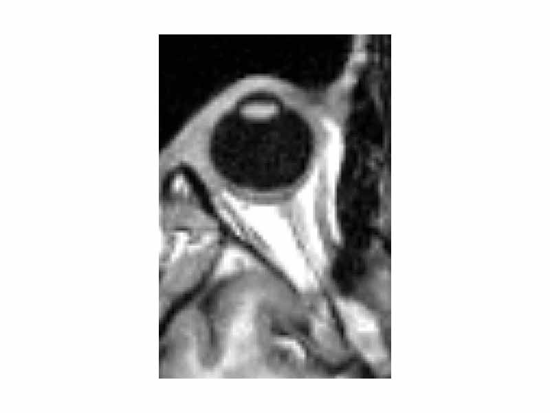 MRI scan of human eye showing optic nerve