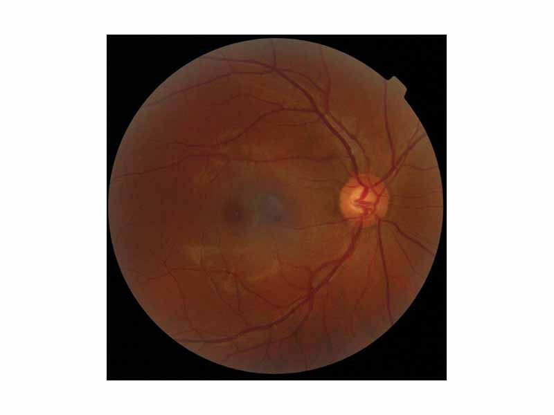 Retinography photograph showing the optic disc as a bright area on the right where blood vessels converge.