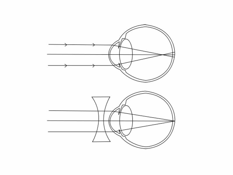 Compensating for myopia using a corrective lens.