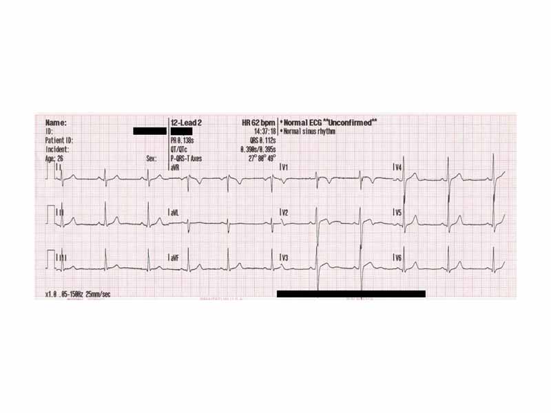 12 Lead ECG of a 26 year old male.