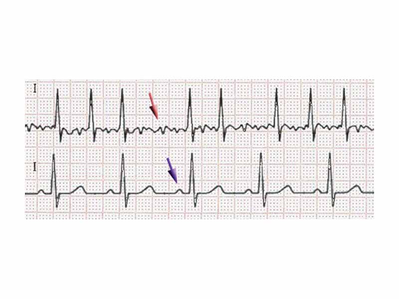 ECG of atrial fibrillation (top) and sinus rhythm (bottom). The purple arrow indicates a P wave, which is lost in atrial fibrillation.