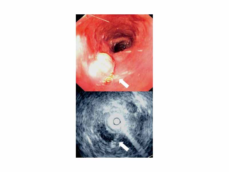 Endoscopy and radial endoscopic ultrasound images of submucosal tumour in mid-esophagus. Permission obtained from patient to release into public domain