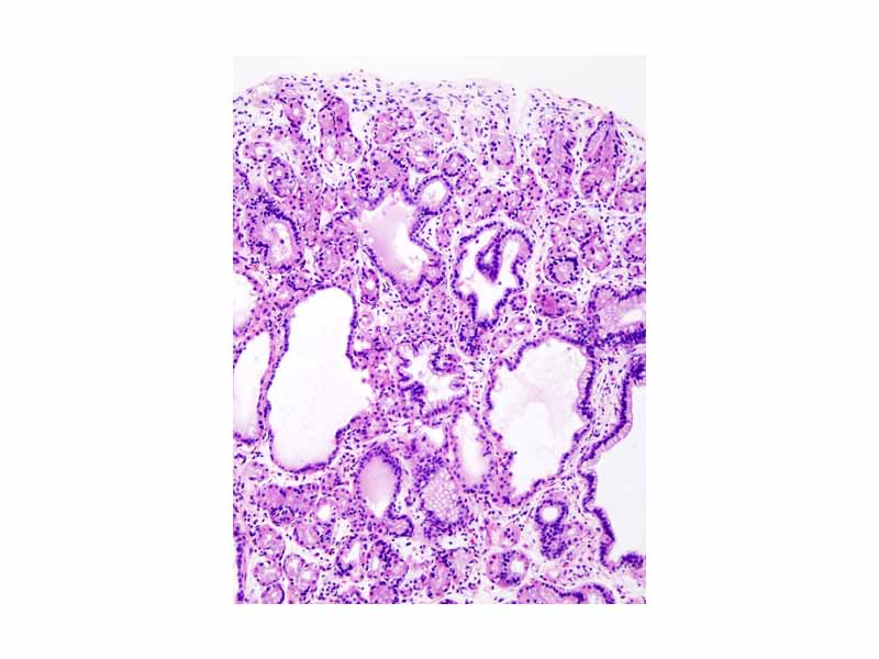 H&E stain of fundic gland polyp showing shortening of the gastric pits with cystic dilatation