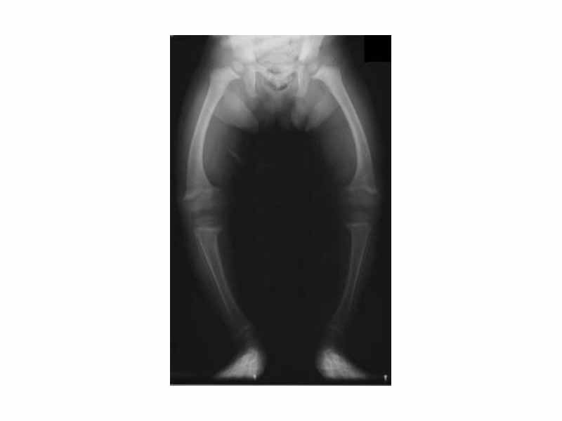 Radiograph of a two-year old rickets sufferer, with a marked genu varum (bowing of the femurs) and decreased bone opacity, suggesting poor bone mineralization.