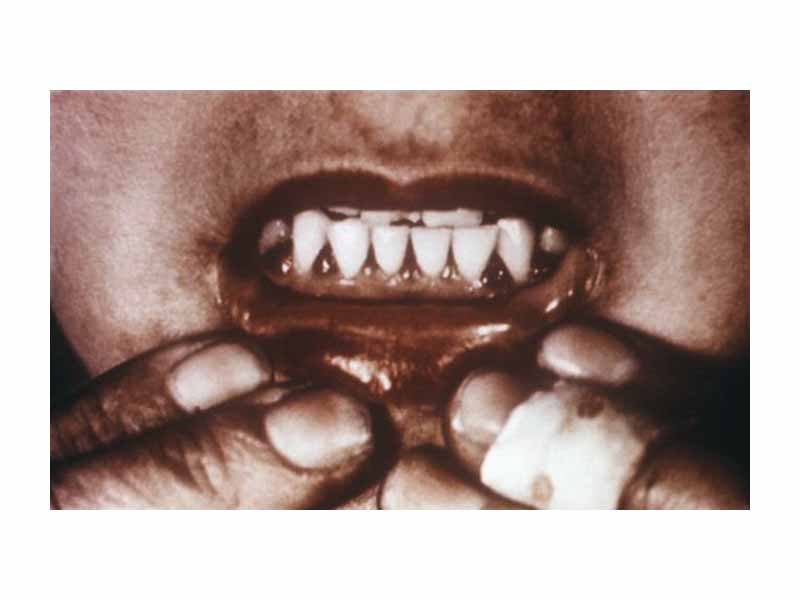 Scorbutic gums, a symptom of scurvy