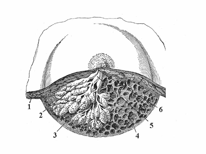 Dissection of a lactating breast.  -  1 - Fat  -  2 - Lactiferous duct/lobule  -  3 - Lobule  -  4 - Connective tissue  -  5 - Sinus of lactiferous duct  -  6 - Lactiferous duct  