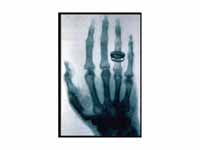 An X-ray picture (radiograph), taken ...