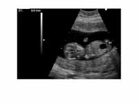 Ultrasound of fetus with Down syndrom...