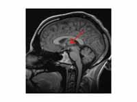 MRI cross-section of human brain, wit...