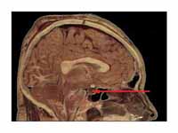 Location of the pituitary gland in th...
