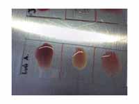 Blood group O positive: neither anti-...