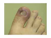 Infected ingrown toenail showing the ...