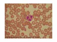 A blood smear showing a Neutrophil Gr...