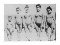 A family with rickets