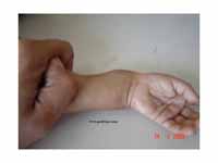Rachitis The wrist widening of rickets